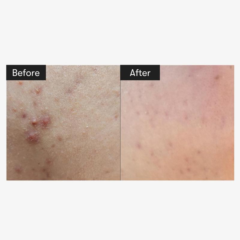 VT_COSMETICS_Reedle_Shot_100_Essence-1